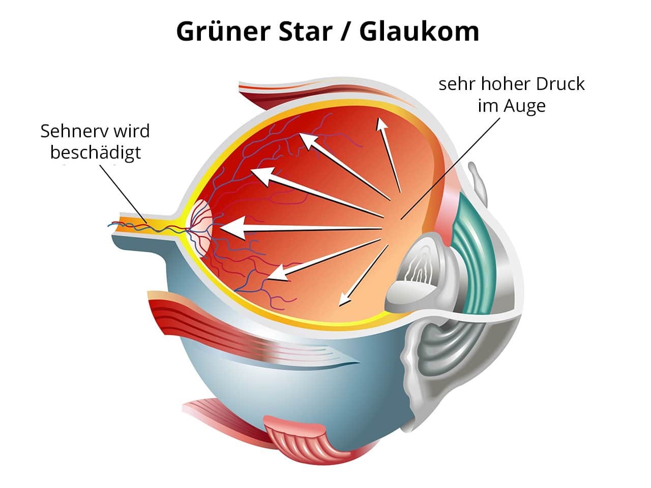 Grüner Star Glaukom