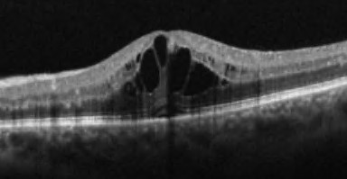 optischen Cohärenz – Tomographie (OCT)